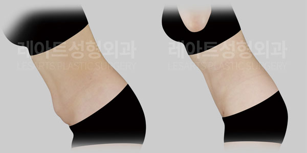 lesarts abdominoplasty before and after