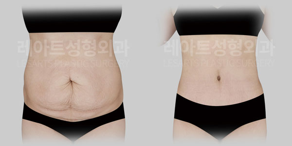 lesarts abdominoplasty before and after