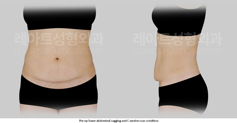 abdominoplasty-02-01-251201