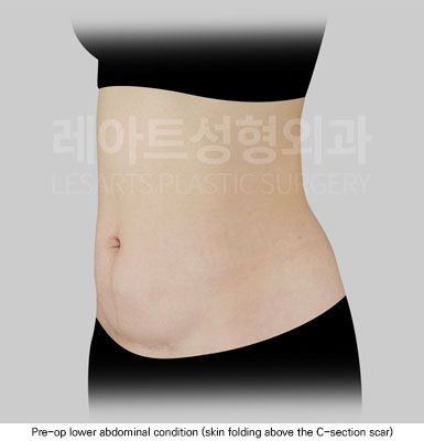 abdominoplasty-02-01-251205