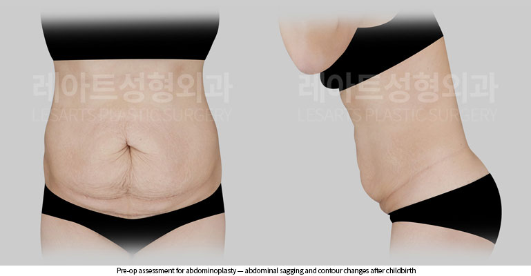 abdominoplasty-02-01-260522