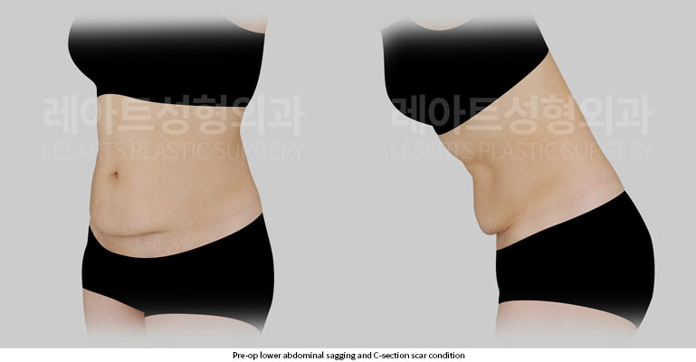 abdominoplasty-02-02-251201