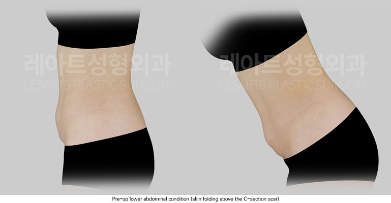 abdominoplasty-02-02-251205