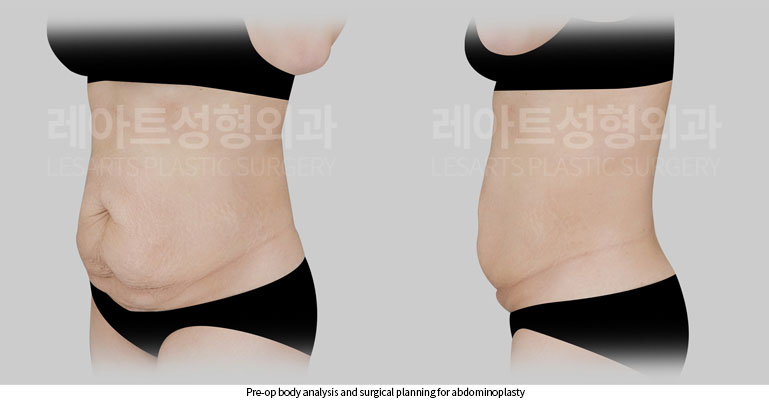 abdominoplasty-02-02-260522