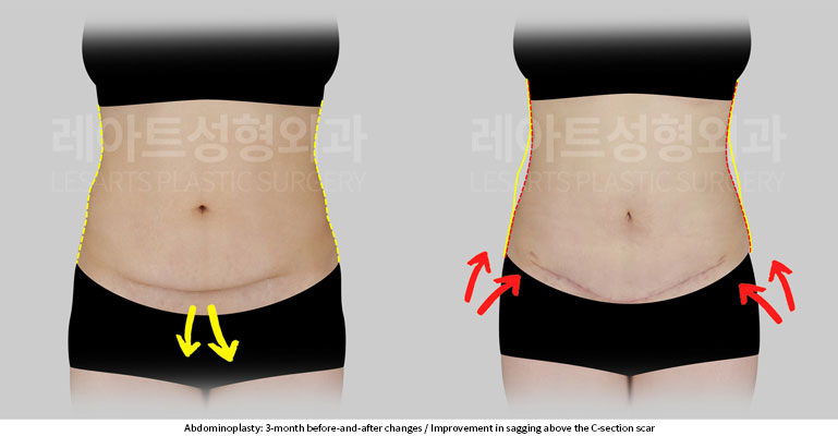 abdominoplasty-02-03-251201