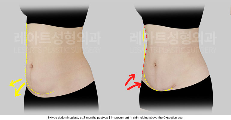 abdominoplasty-02-03-251205