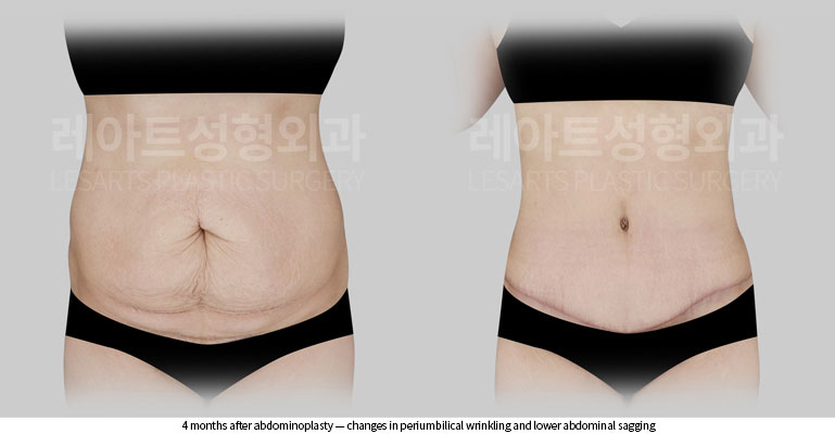 abdominoplasty-02-03-260522