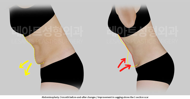 abdominoplasty-02-04-251201