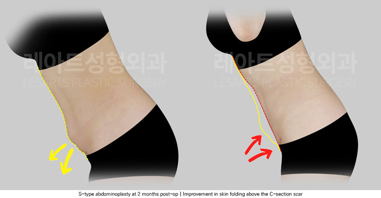abdominoplasty-02-04-251205