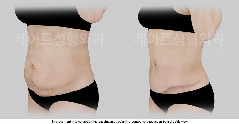 abdominoplasty-02-04-260522