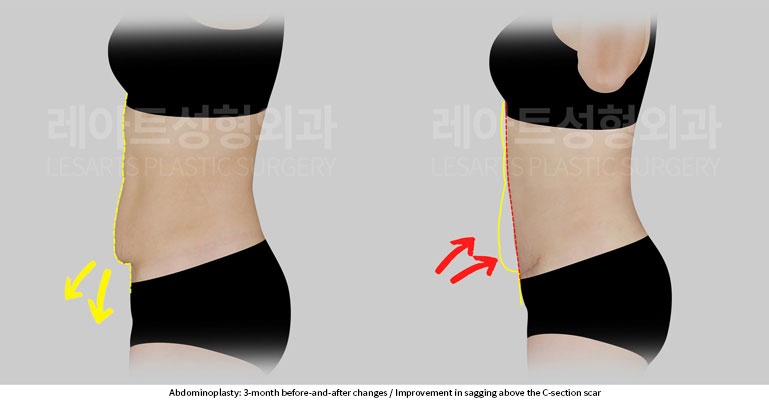 abdominoplasty-02-05-251201