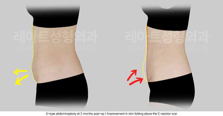 abdominoplasty-02-05-251205
