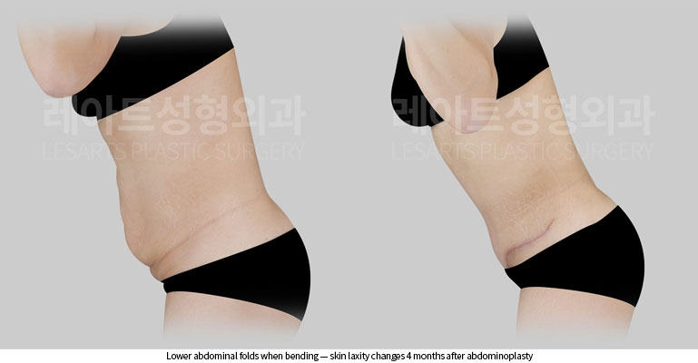 abdominoplasty-02-05-260522