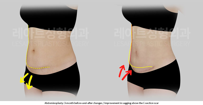 abdominoplasty-02-06-251201