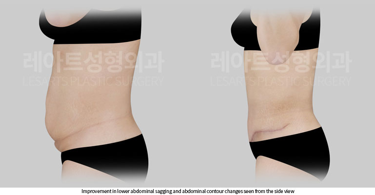 abdominoplasty-02-06-260522