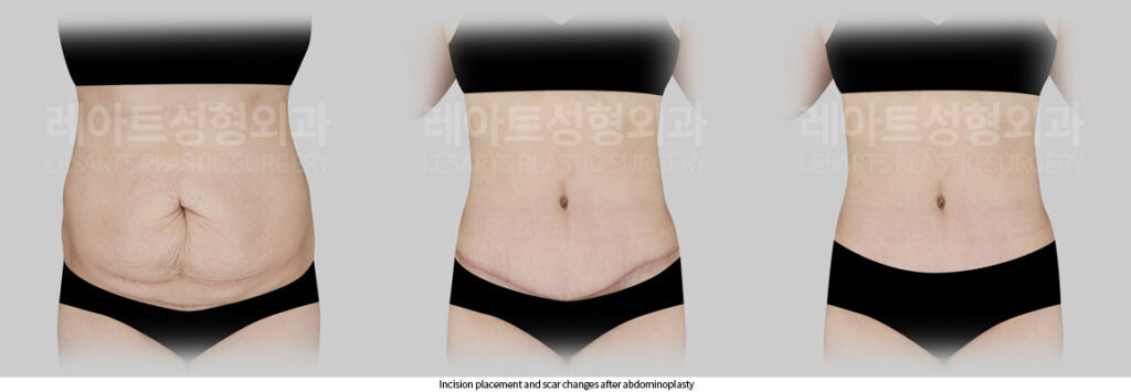 abdominoplasty-02-07-260522