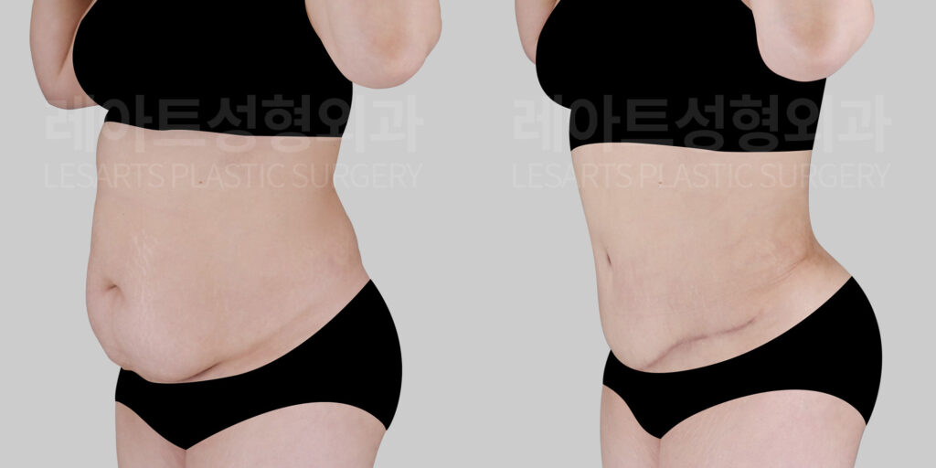 abdominoplasty before and after-lesarts