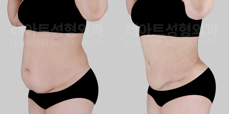 abdominoplasty before and after-lesarts