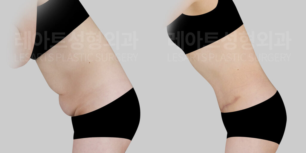 lesarts-abdominoplasty-before-after