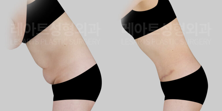 lesarts-abdominoplasty-before-after