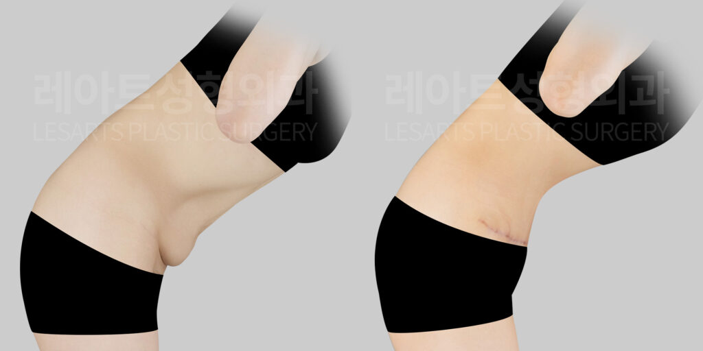 abdominoplasty before and after