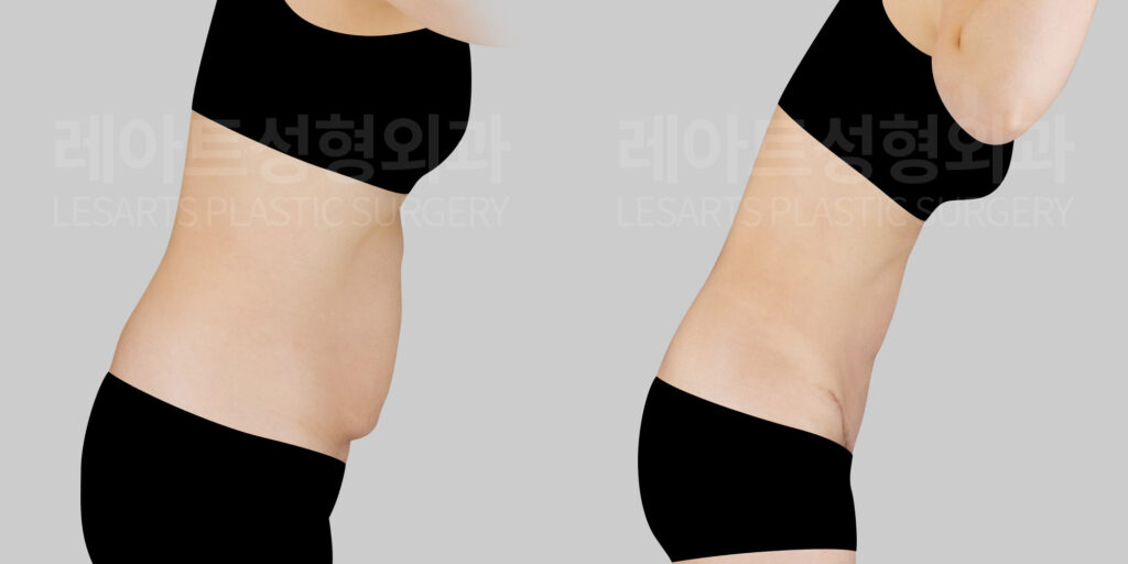 lesarts-abdominoplasty before and after(bending)