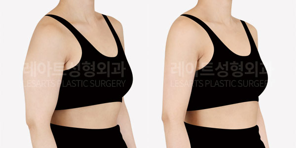 lesarts arm liposuction before and after