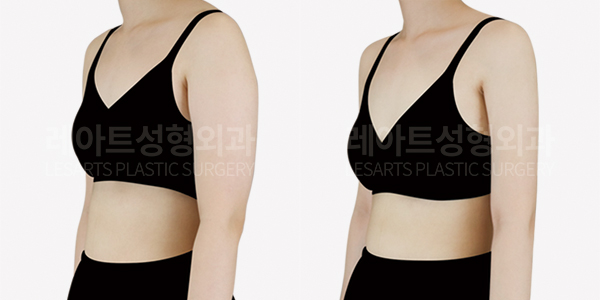 lesarts arm liposuction before and after