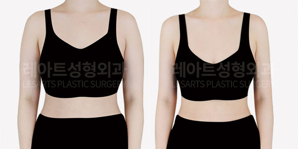 arm liposuction before and after