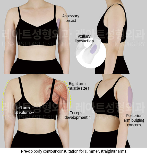 arm-liposuction-02-01-250522