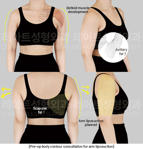arm-liposuction-02-01-251209