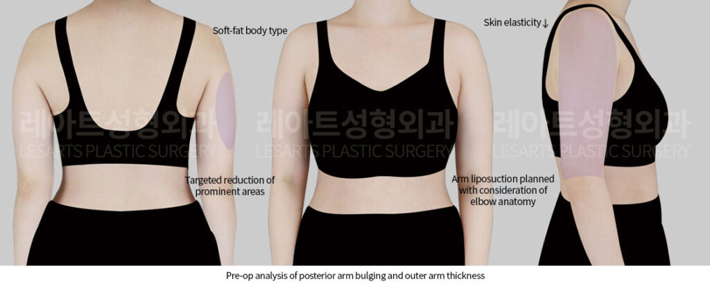 arm-liposuction-02-01-260527