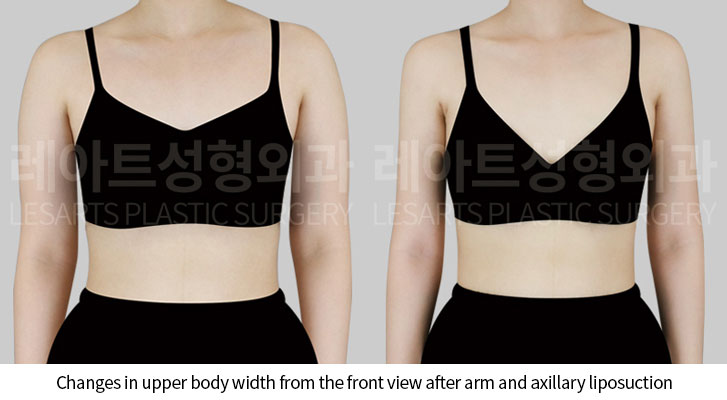 arm-liposuction-02-02-250522