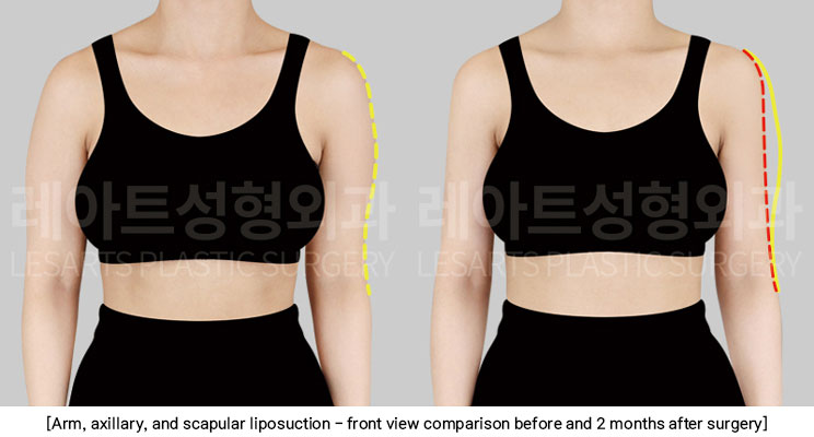 arm-liposuction-02-02-251209