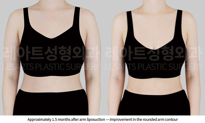 arm-liposuction-02-02-260527