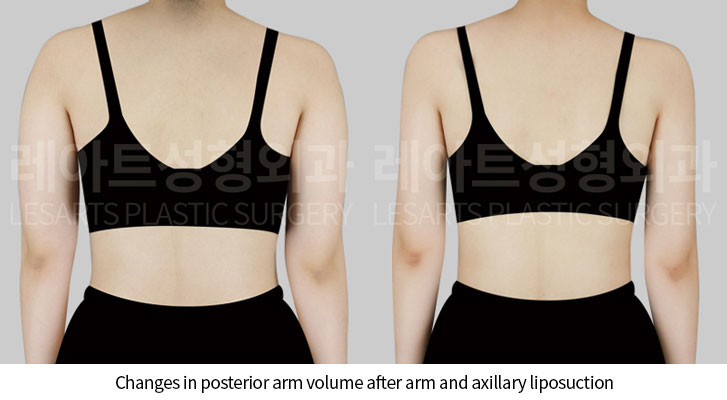 arm-liposuction-02-03-250522