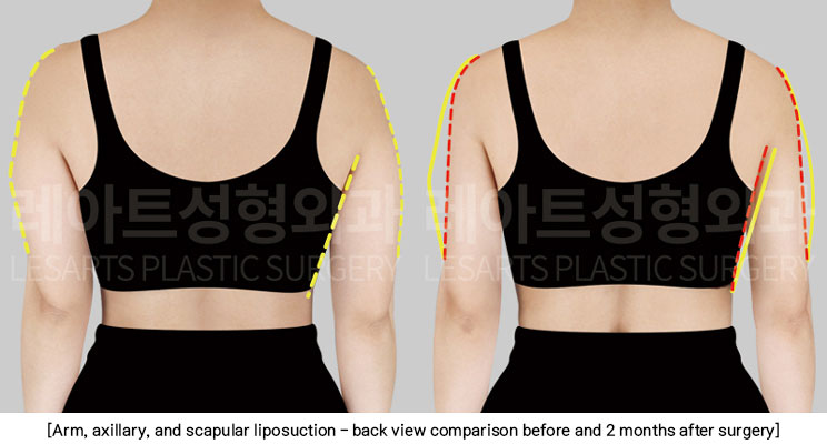arm-liposuction-02-03-251209
