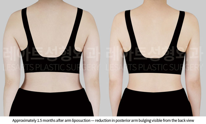 arm-liposuction-02-03-260527