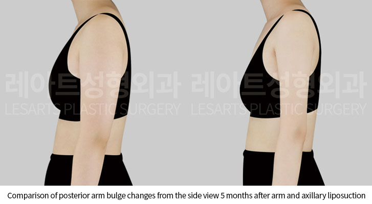 arm-liposuction-02-04-250522