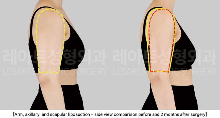 arm-liposuction-02-04-251209