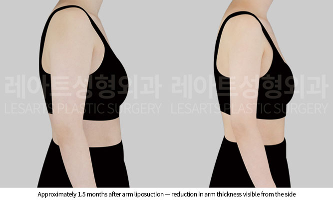 arm-liposuction-02-04-260527