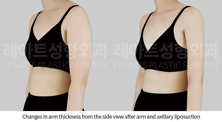 arm-liposuction-02-05-250522