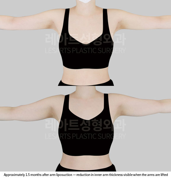 arm-liposuction-02-05-260527