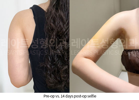 arm-liposuction-02-06-250522