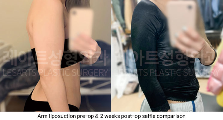 arm-liposuction-02-06-251209