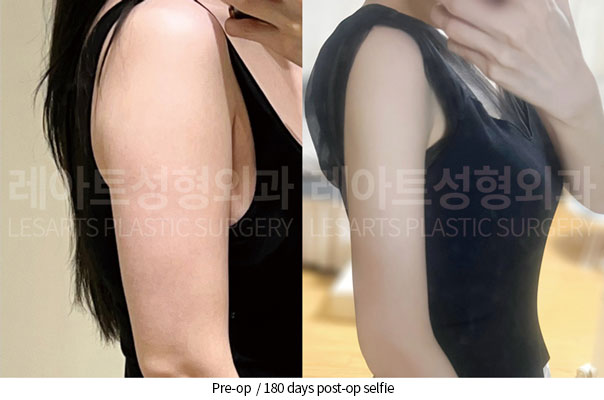 arm-liposuction-02-06-260527
