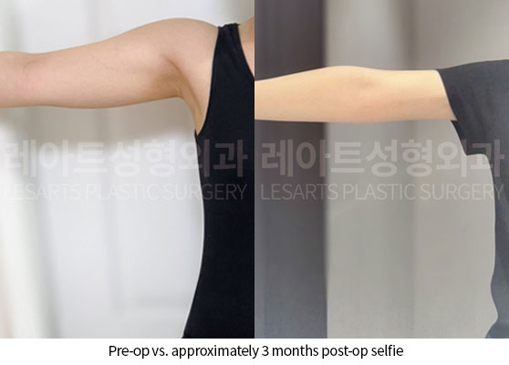 arm-liposuction-02-07-250522