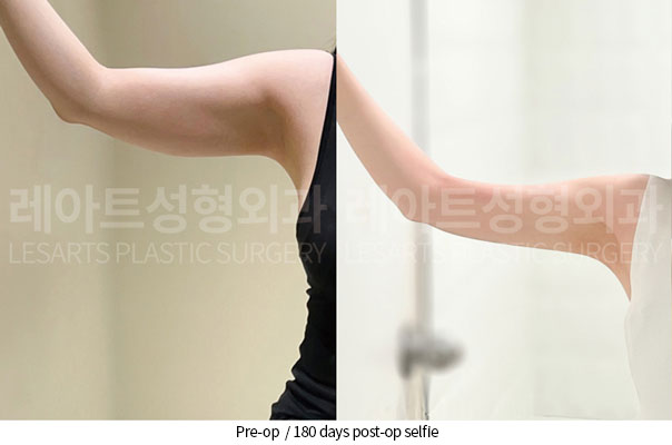 arm-liposuction-02-07-260527