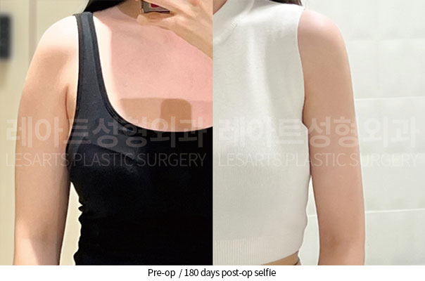 arm-liposuction-02-08-260527
