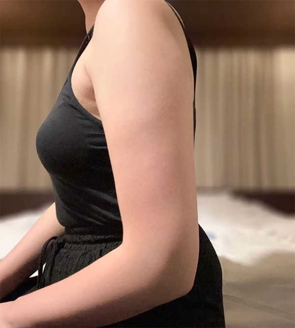 arm-liposuction-Bbaebbaemombbaesalbbae-before